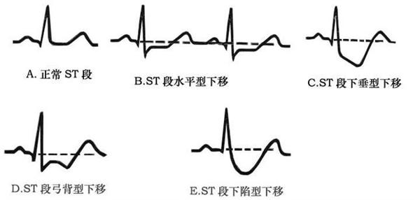 窦性心率不齐别着急,跟着豪斯医生学看心电图